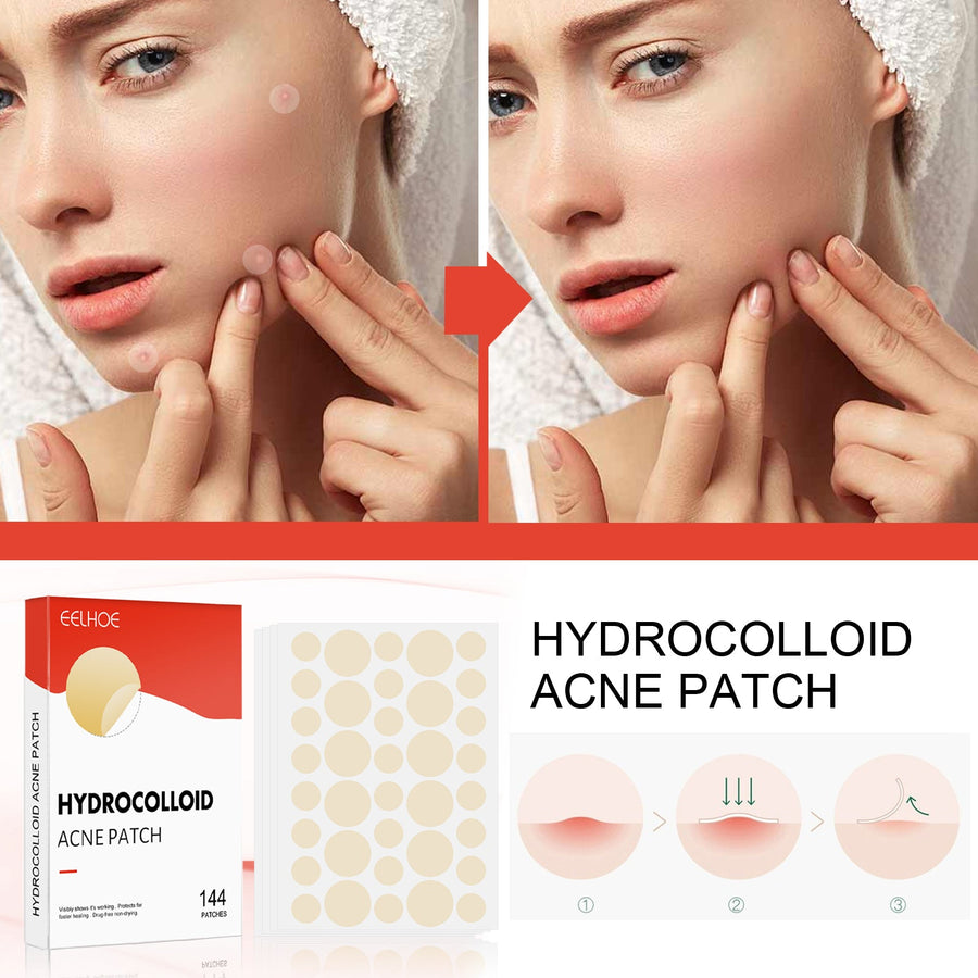 Hydrocolloid Acne Patches – Invisible Pimple Treatment, 144 Count