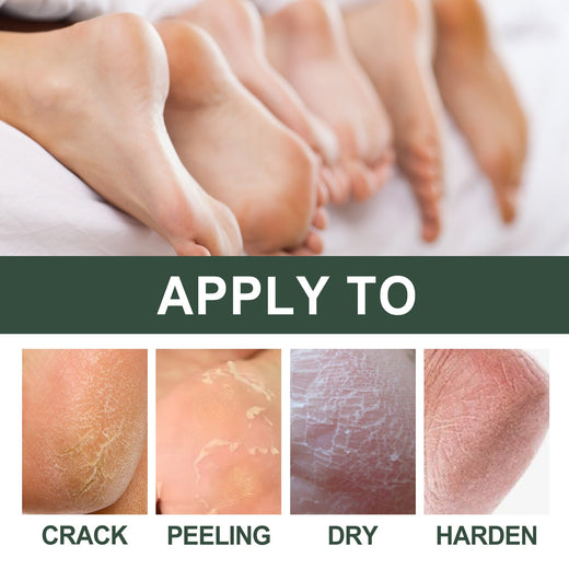 Cracked Heel Cream for Softer Hands, Feet & Calluses