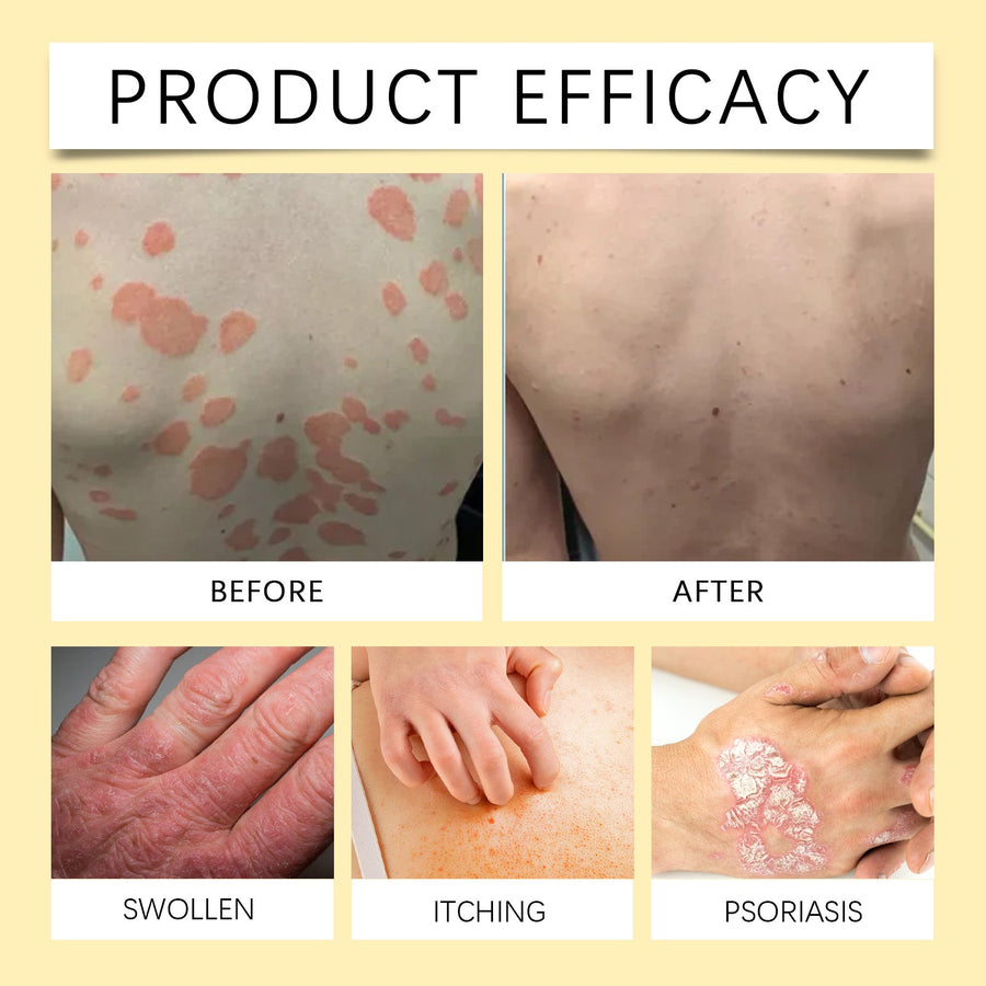 OCEAURA Herbal Psoriasis Care Soap, Soothing And Moisturizin