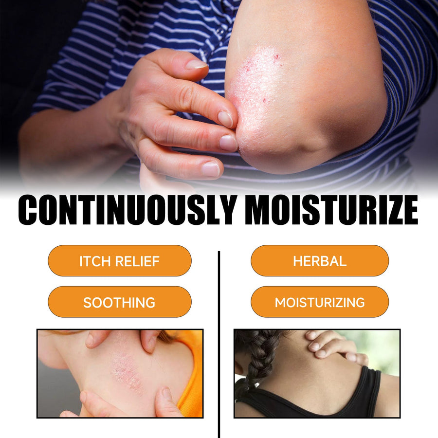 Bee Venom Psoriasis Spray for Itch and Flare Relief
