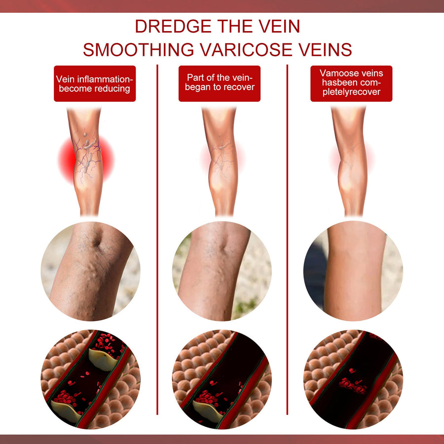 Varicose Vein Cream & Patches — Smoother Legs, Less Swelling