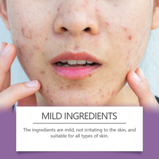 Acne Patches for Blemishes | Colorful Spot Coverage