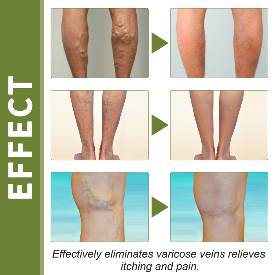 Varicose Vein Therapy Cream – Leg Relief & Spider Vein Repair