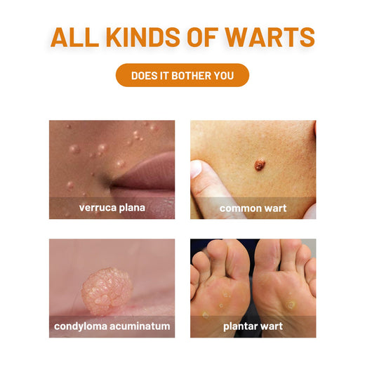 Bee Venom Wart Treatment Spray — Clear Skin in 8 Weeks