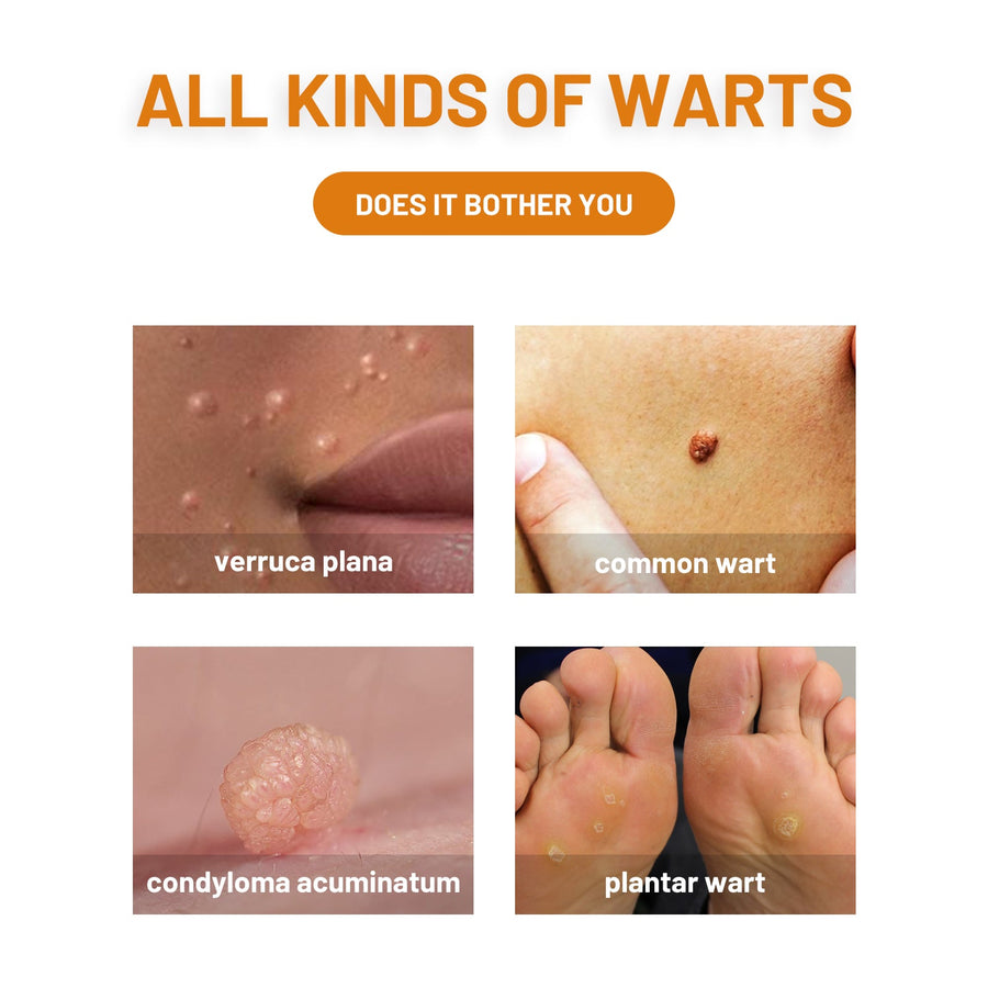 Bee Venom Wart Treatment Spray — Clear Skin in 8 Weeks