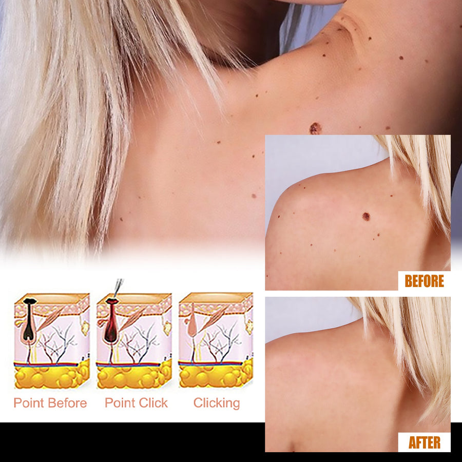 Skin Essence Mole Removal Serum – Smooth Clear Skin
