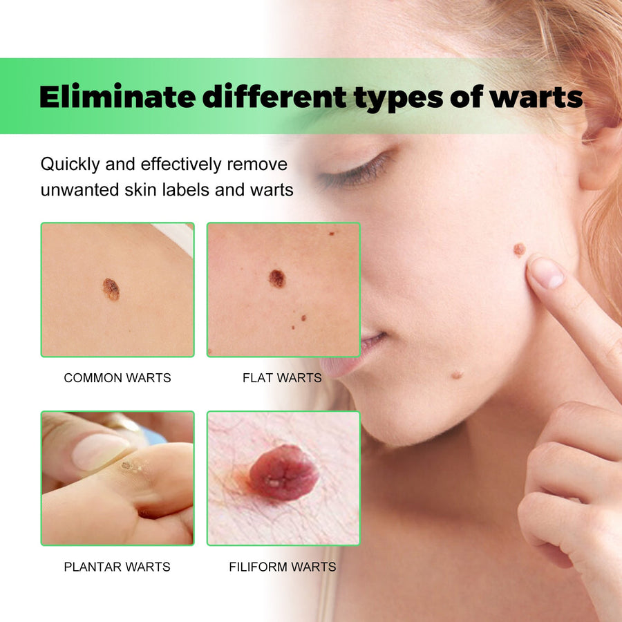 Skin Tag & Wart Removal Soap — Pain & Scar-Free Treatment