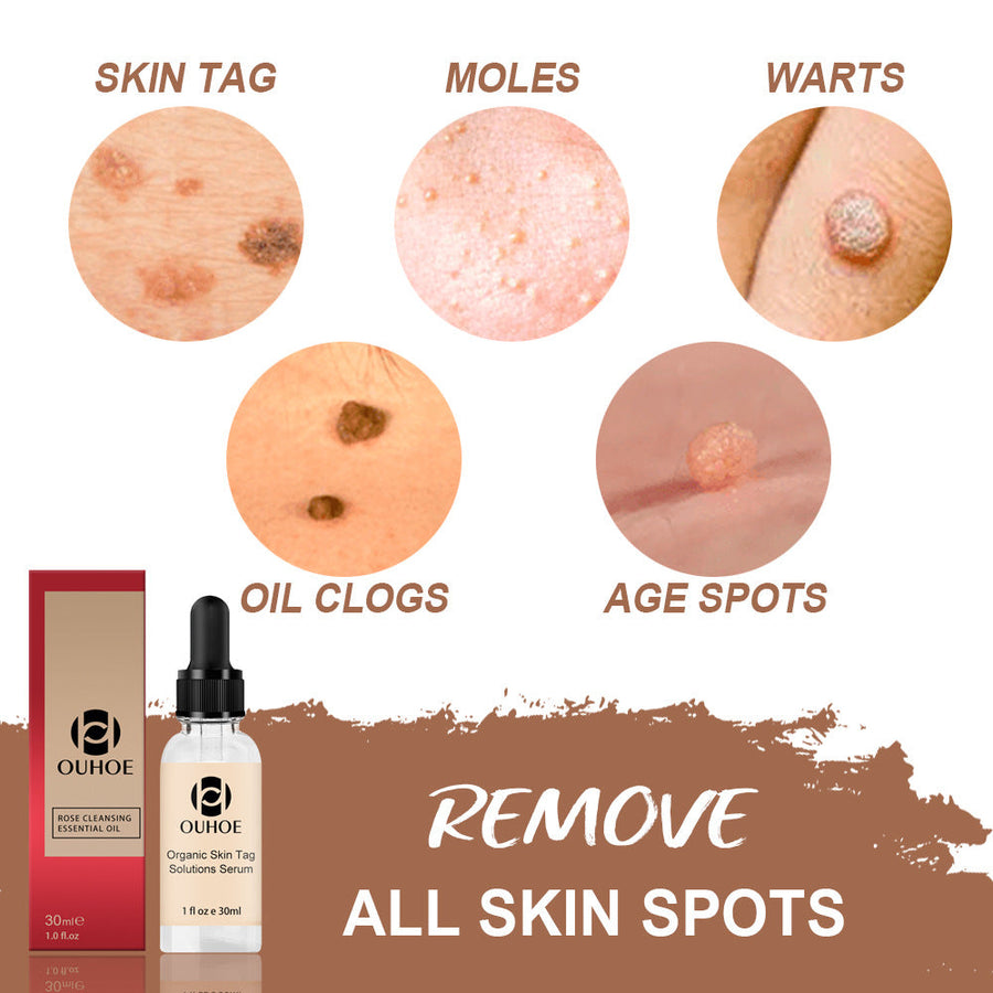 Removing Nevus Liquid Removing Nevus Cream Repair Removing N