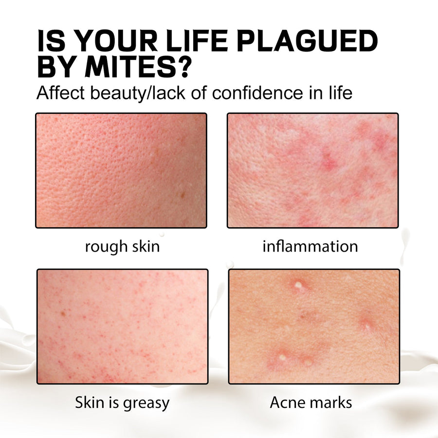 Aurora Mite-Removing Soap for Acne-Prone Skin