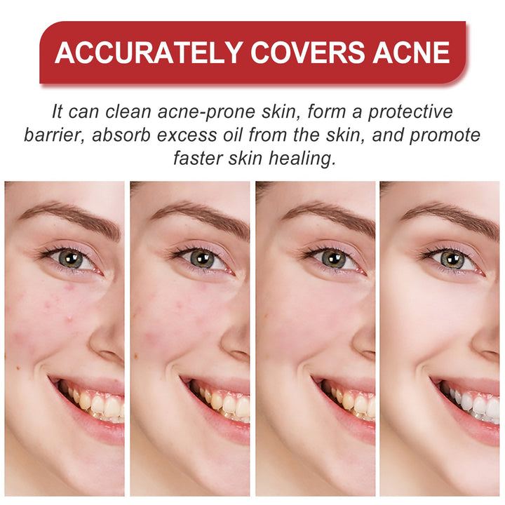 Hydrocolloid Acne Patches - Cute Shapes, 180 Count Pack