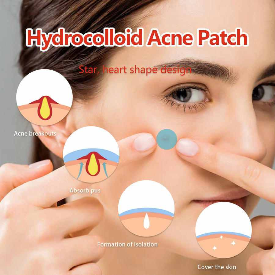 Hydrocolloid Pimple Patches — 144-Piece Set with Visible