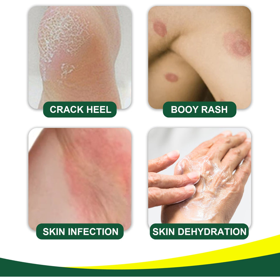 Herbal Tinea Cream for Fungal Itch & Rash Relief