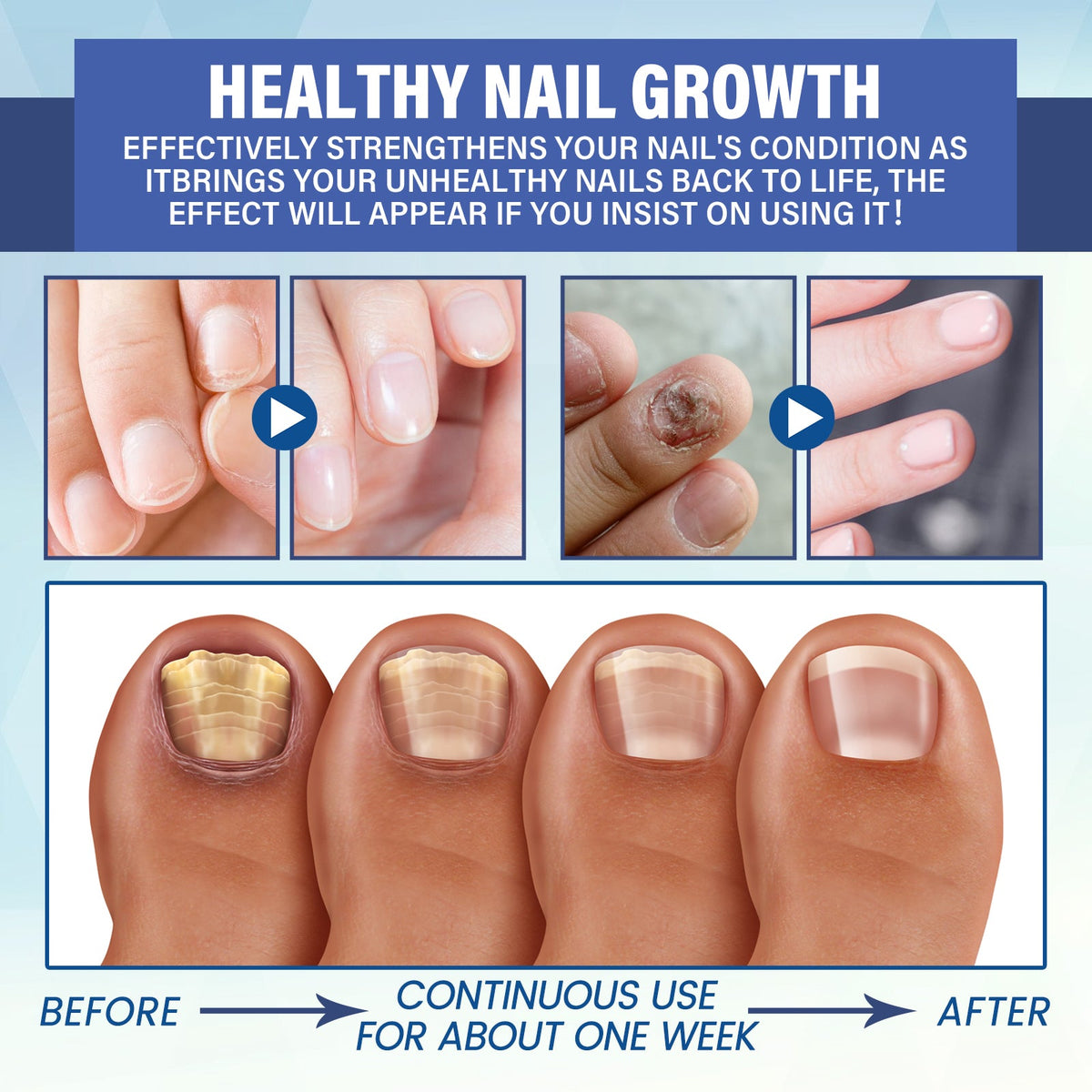 LED Nail Repair Treatment — Clear Fungus & Restore Nail