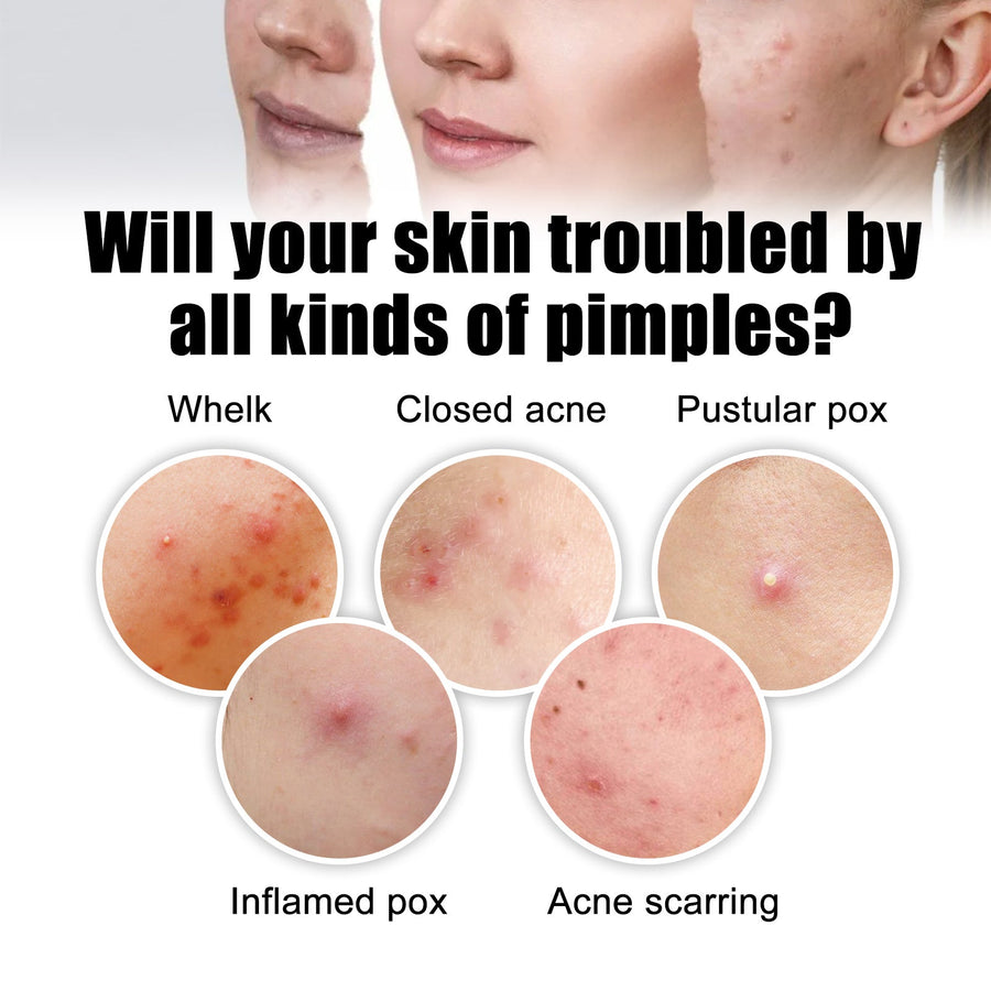 Acne Spot Patches — Treat All Pimples Invisibly, Day & Night