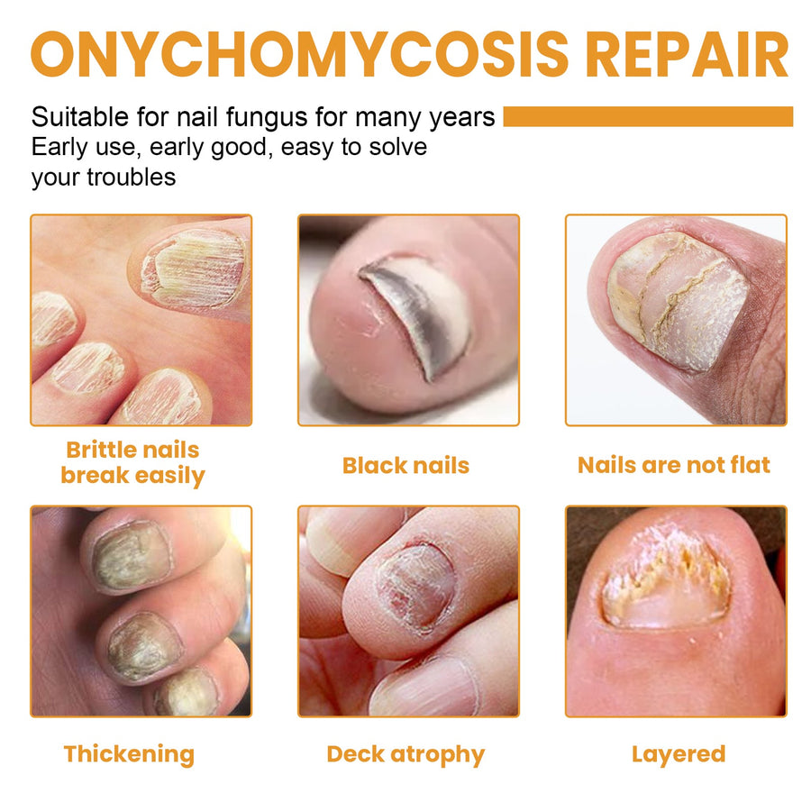 Fungal Nail Patches — Overnight Renewal for Clearer Nails