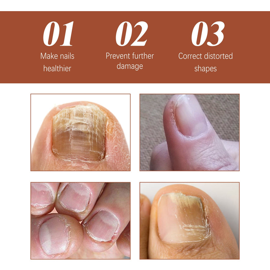 Nail Repair Essence for Discolored Brittle Nails Serum