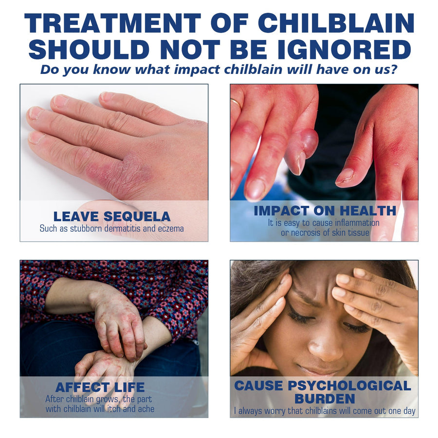 Chilblain Relief Cream – Heals Severe Cracking & Peeling Fast