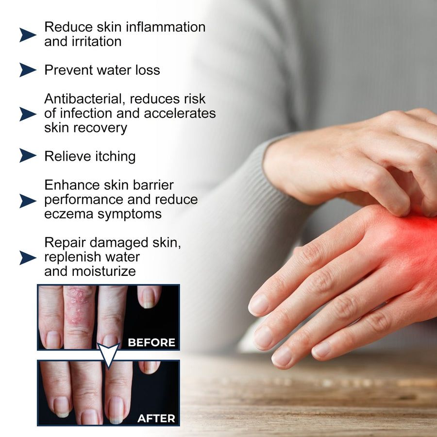 Eczema Therapy Spray — Fast-Acting Relief & Skin Barrier Repair