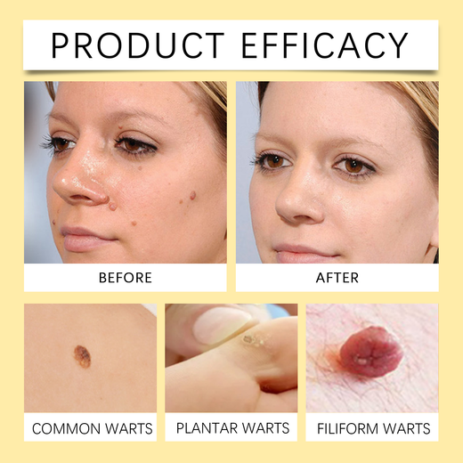 Bee Venom Wart & Mole Removal Spray, Gentle Cleansing Skin M