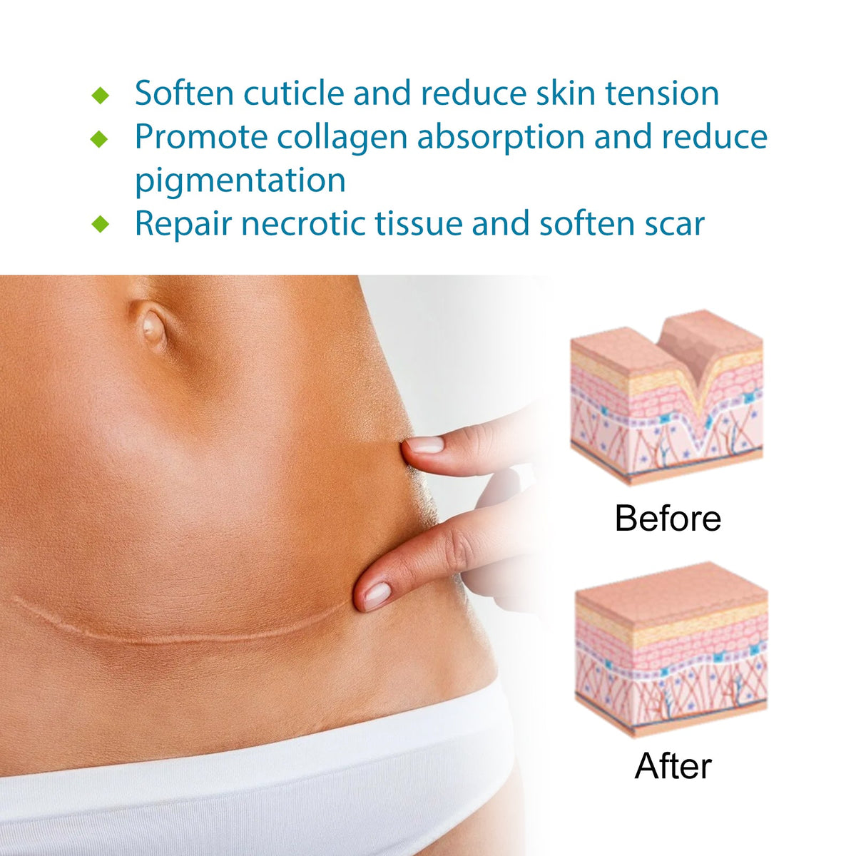 Silicone Scar Treatment — Cut-to-Fit Smoother-Looking Care