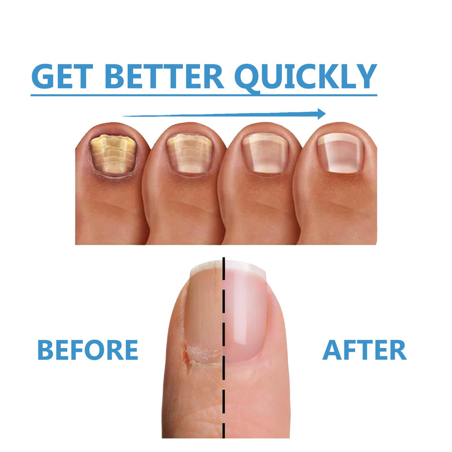 Toenail Fungus Treatment — Maximum Strength Repair