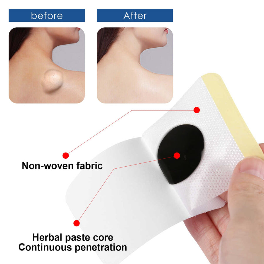 Lipoma Removal Patch — Dissolve Subcutaneous Lumps Naturally