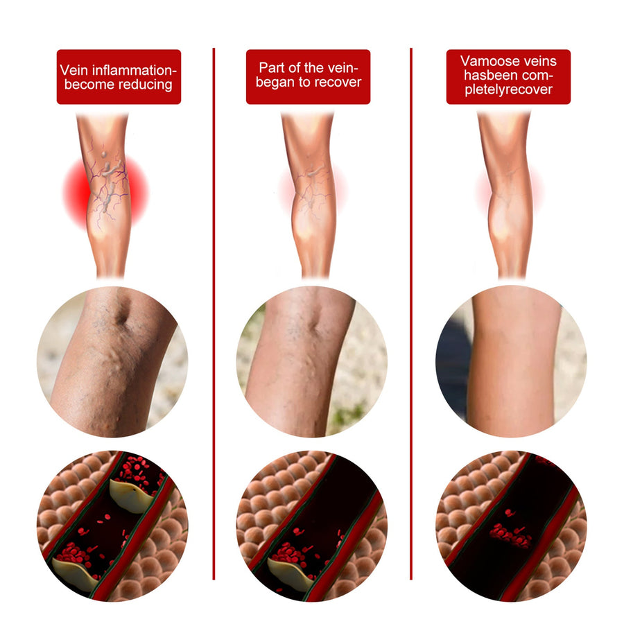 Varicose Veins Relief Spray – Rapid Leg Pain & Spider Vein
