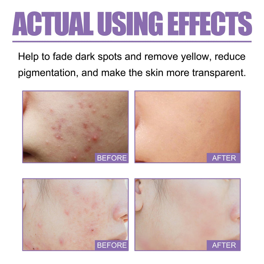 Lavender Acne Soap Bar For Oily Skin Pore Control