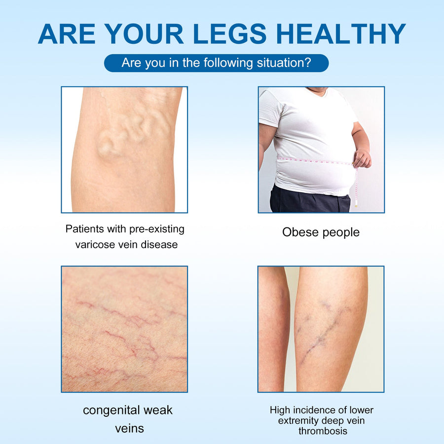 Natural Varicose Vein Cream – Reduces Leg Swelling & Veins