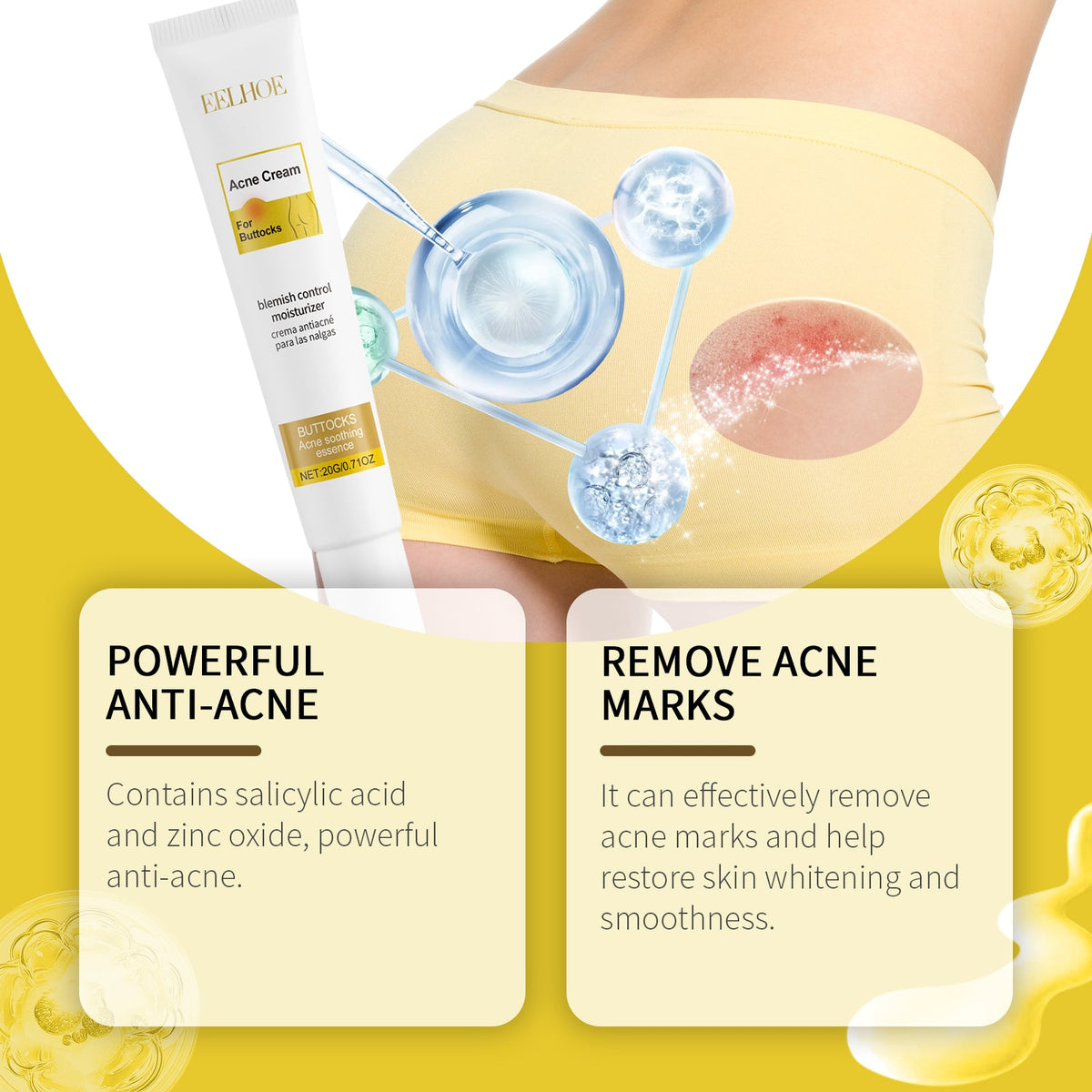 Buttne Acne Cream - Targeted Blemish Control Treatment