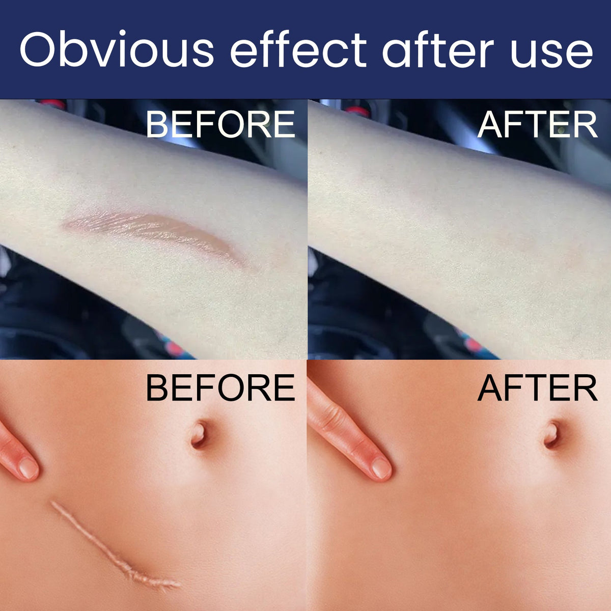 Advanced Silicone Scar Gel - Fades New & Old Scars Visibly