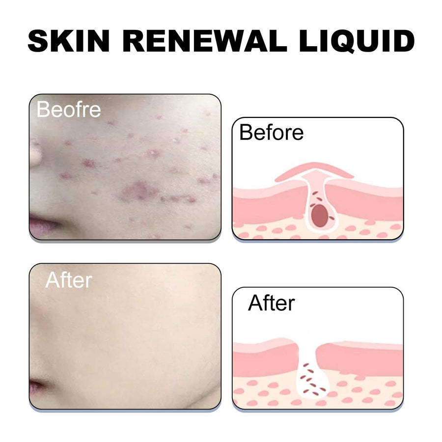 2% BHA Acne Treatment Liquid for Clogged Pores & Breakouts