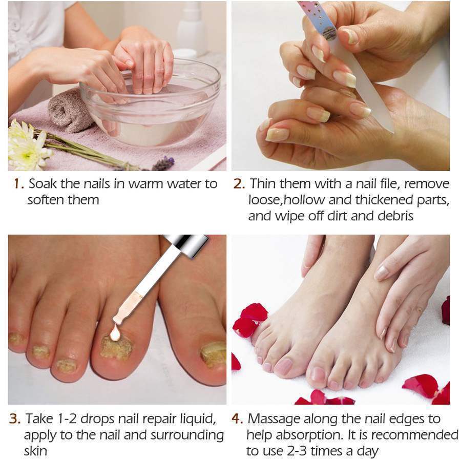 Fungal Toe Nail Treatment for Smoother, Healthier Nails