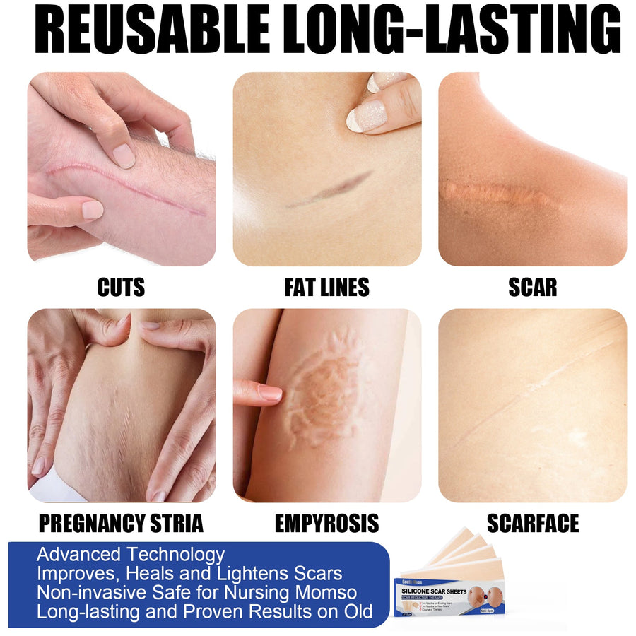 Silicone Scar Sheets for Surgical & Burn Scars