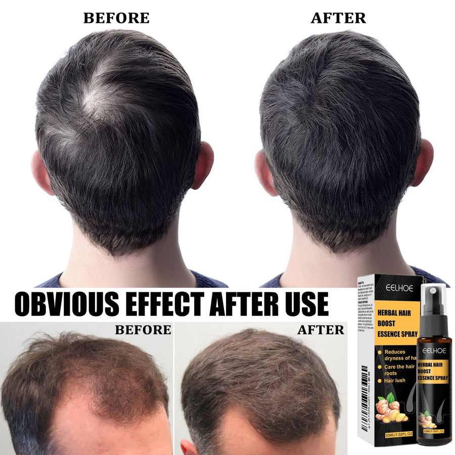 Herbal Scalp Spray & Roller for Dry, Thinning Hair