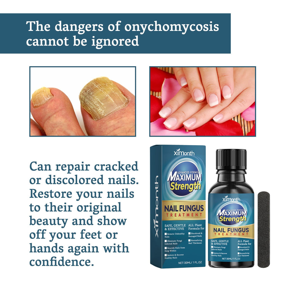 Maximum Strength Nail Fungus Treatment — Clear Nails Fast