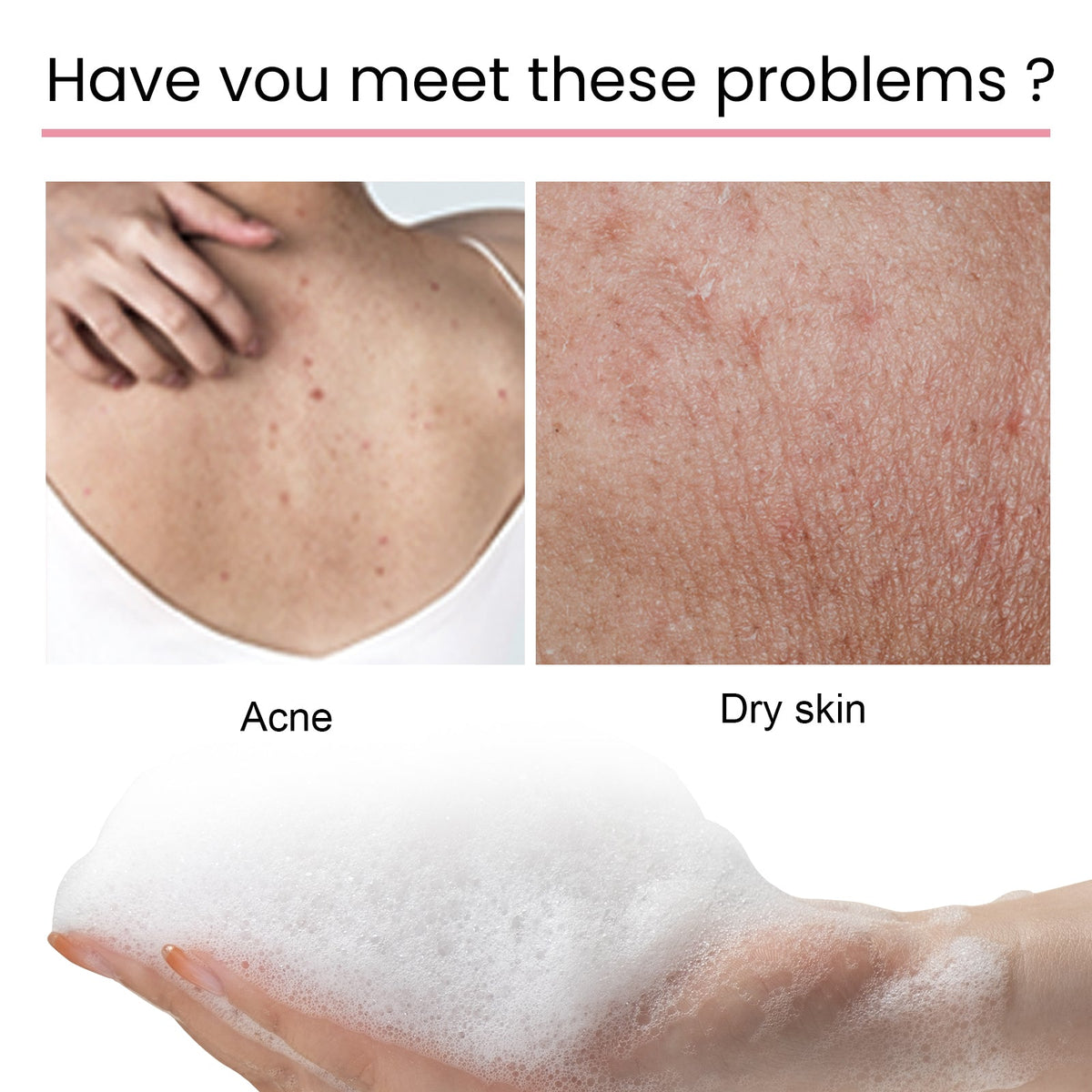 Carbon Clay Back Soap for Body Acne & Dark Spots
