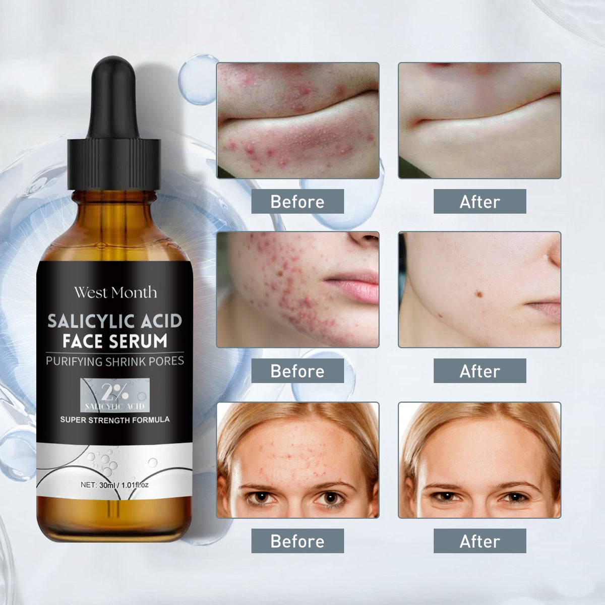 Salicylic Acid Facial Essence, Lighten Acne Mark Repair Hydr