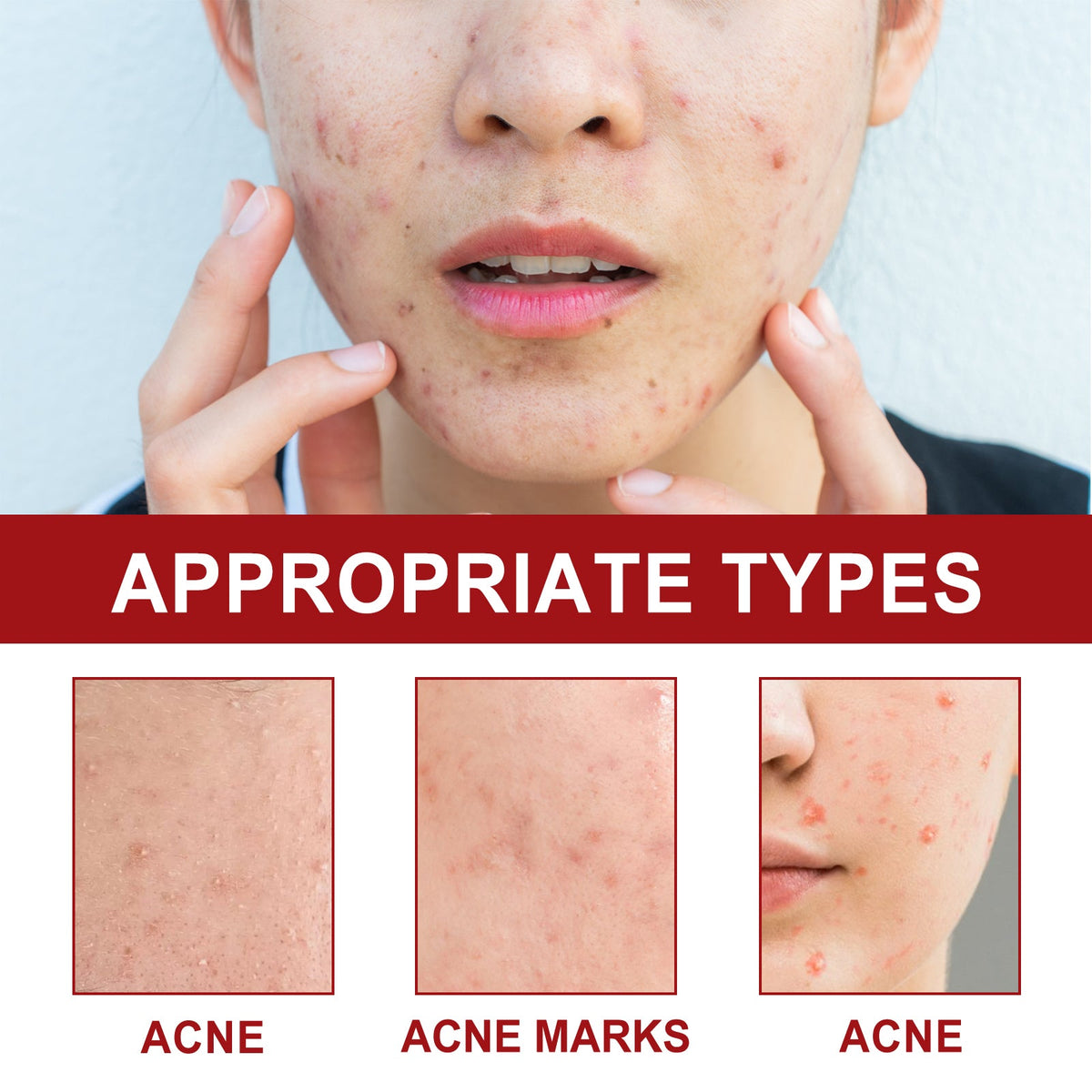 Hydrocolloid Acne Patches - Cute Shapes, 180 Count Pack