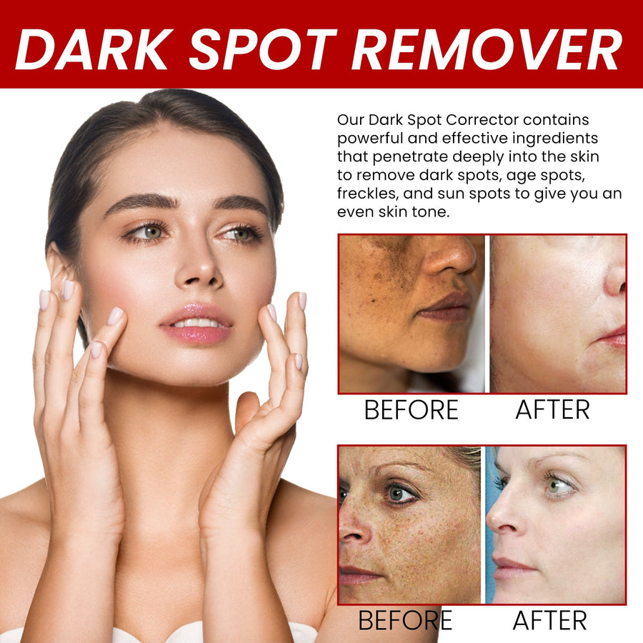 Dark Spot Corrector Cream for Fading Age Spots & Freckles