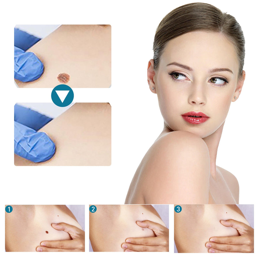 Skin Tag & Mole Removal Patches — 144 Waterproof Patches