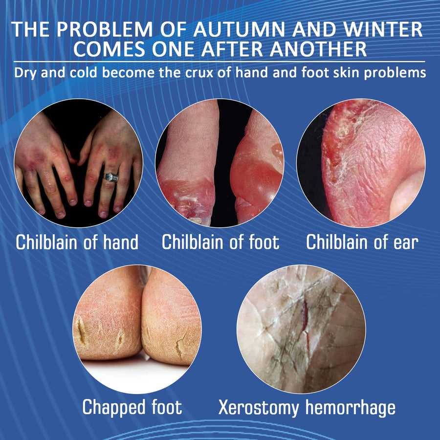 Chilblain Relief Cream – Heals Severe Cracking & Peeling Fast