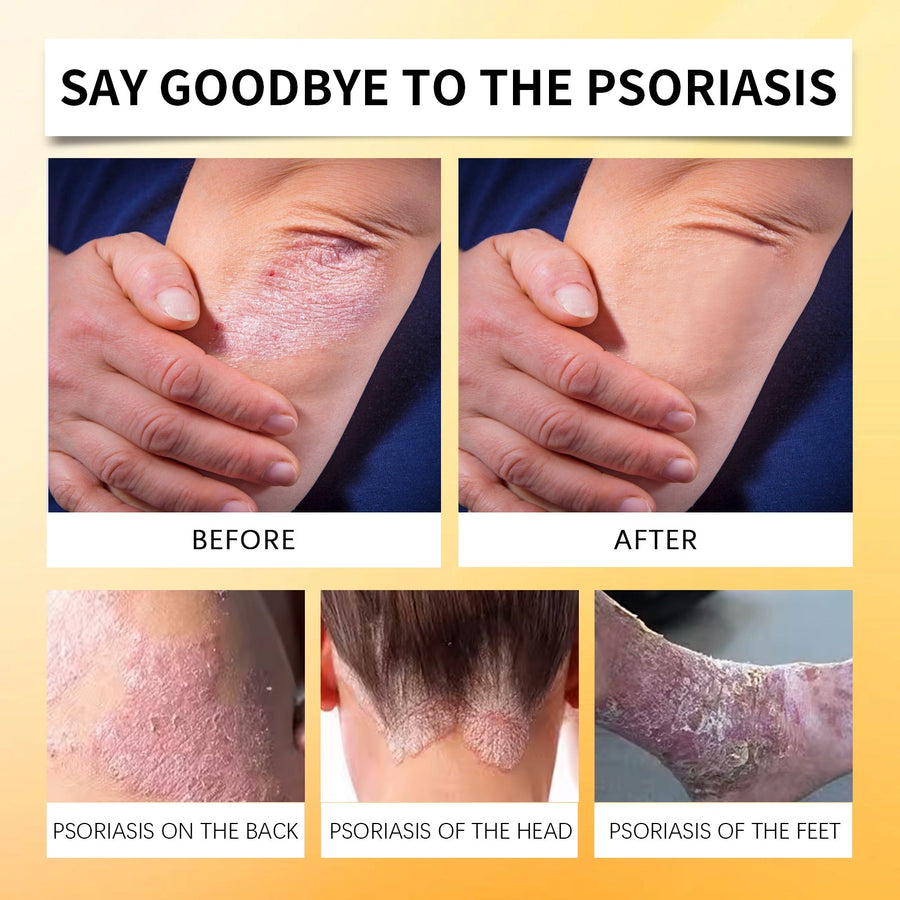 Bee Venom Psoriasis Spray for Itch and Redness Relief