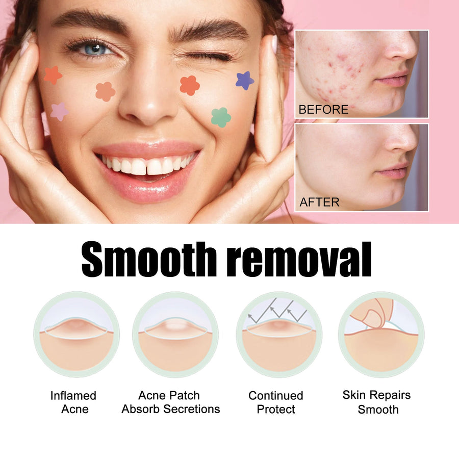 Acne Spot Patches — Treat All Pimples Invisibly, Day & Night