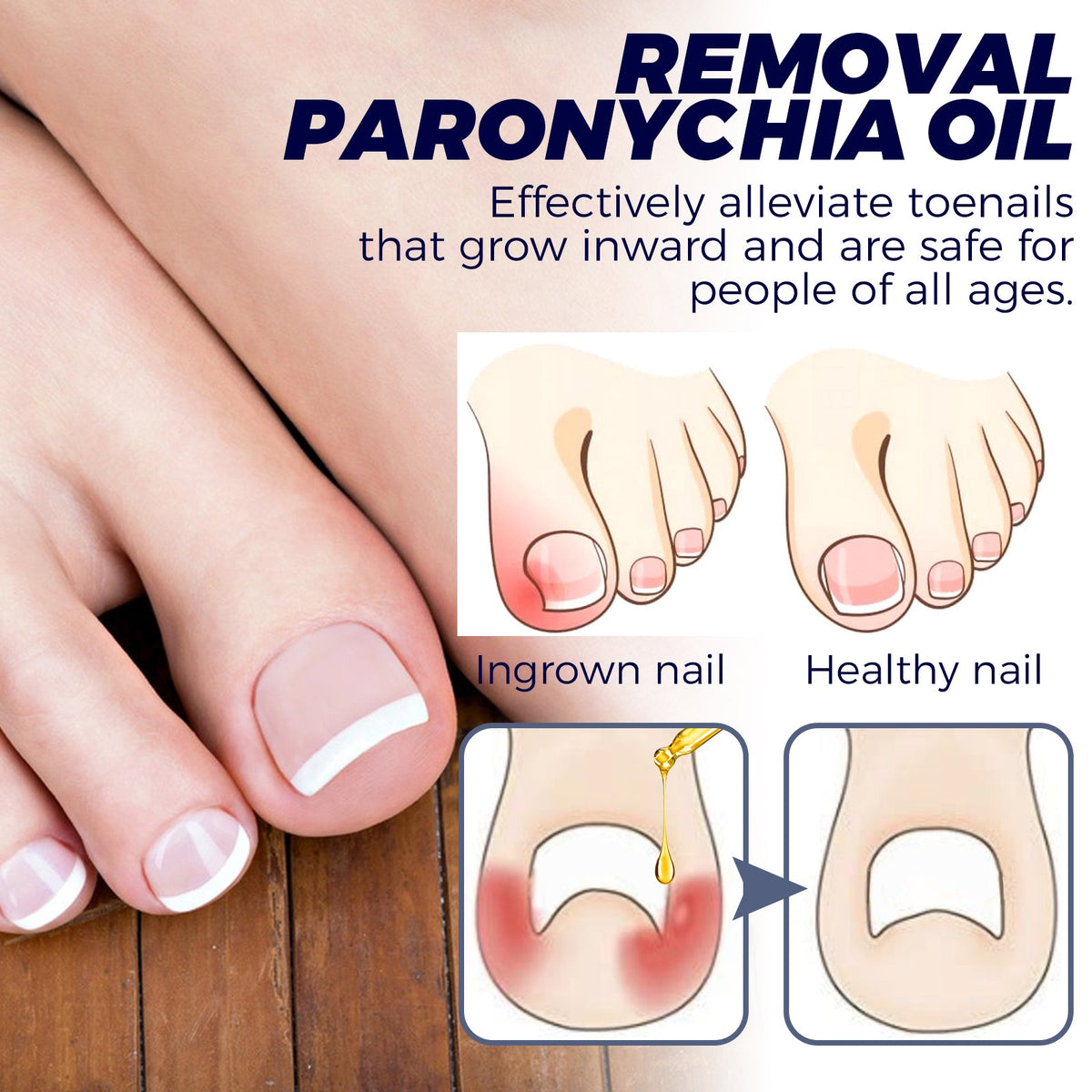 Nail Repair Oil for Ingrown Toenails & Paronychia Relief