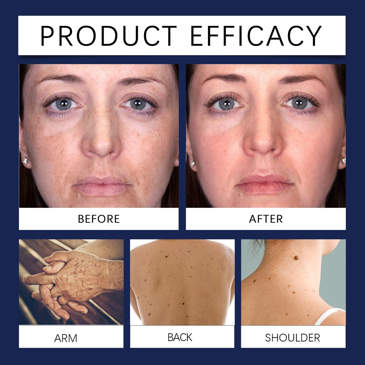 Bee Venom Pigment Correction Spray for Dark Spots