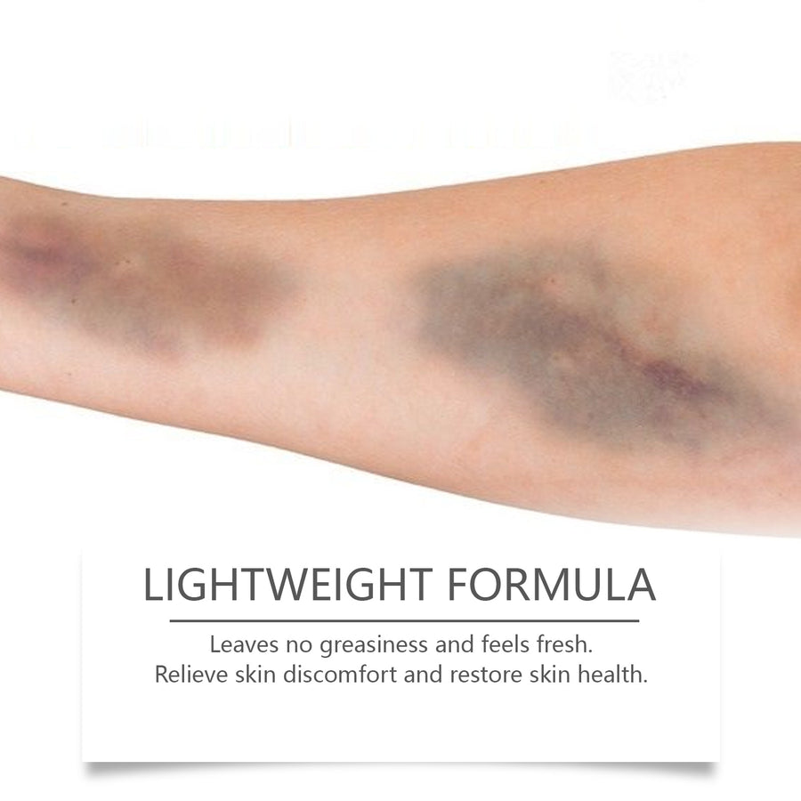 Bruise Relief Spray — Soothe & Heal Bruises Faster