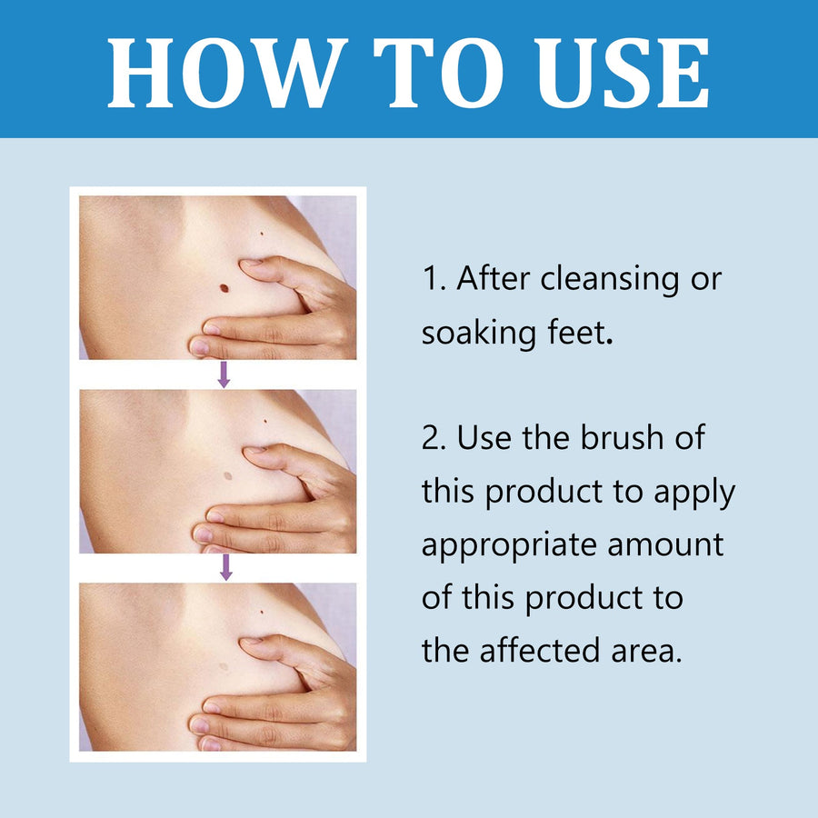 Skin Tag and Wart Removal Liquid — Results in Days