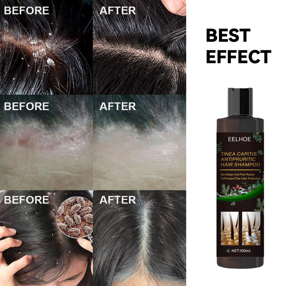 Anti-Dandruff Shampoo for Itchy, Oily Scalp Care