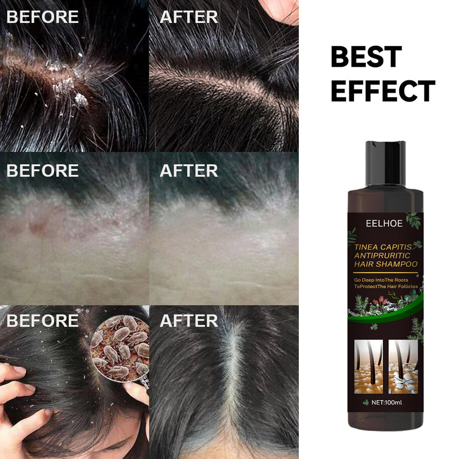 Anti-Dandruff Shampoo for Itchy, Oily Scalp Care